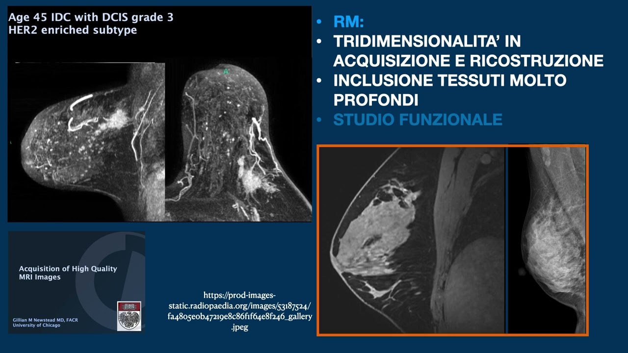 CONFRONTO TRA METODICHE, RM, MAMMOGRAFIA, TOMO E CESM