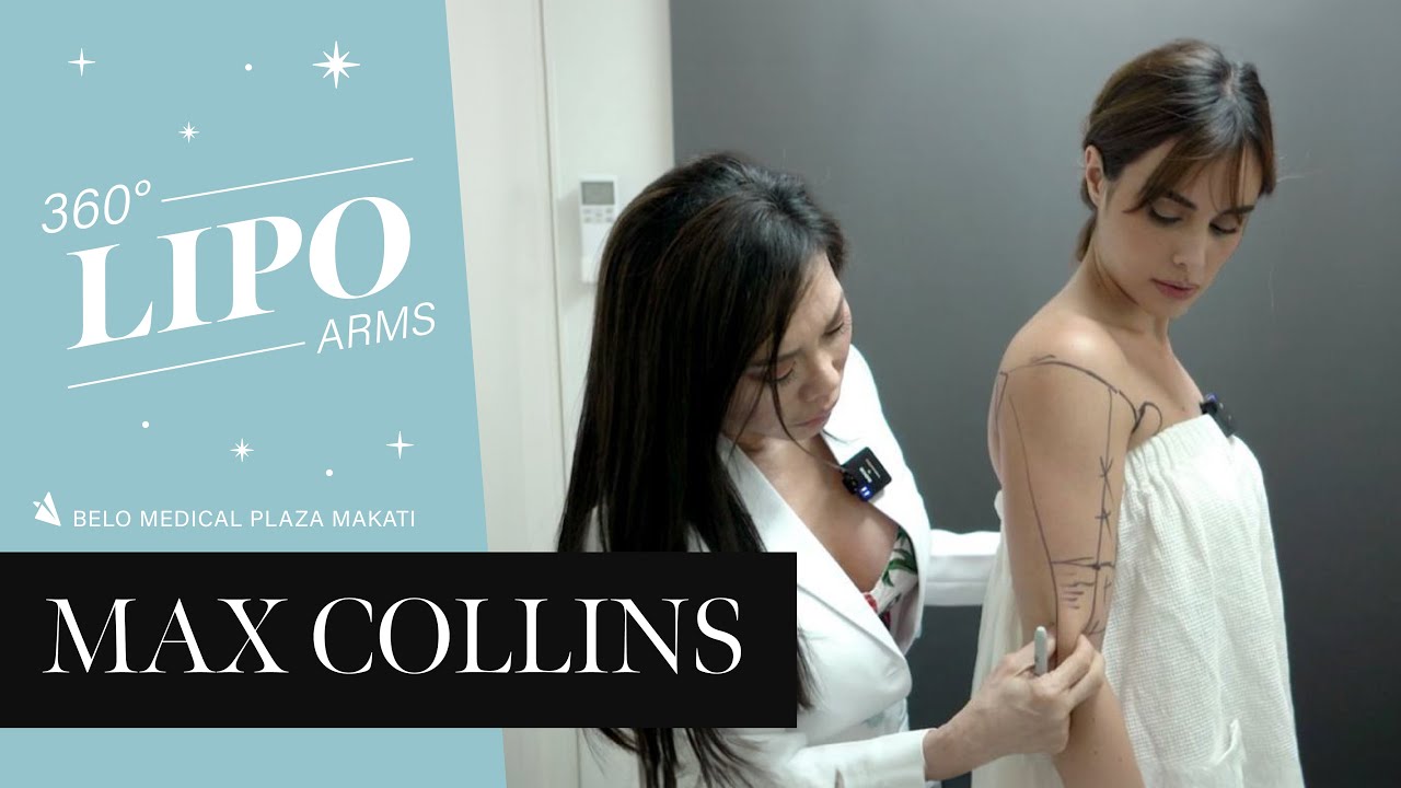 Max tries 360&deg; Liposuction | Belo Medical Group