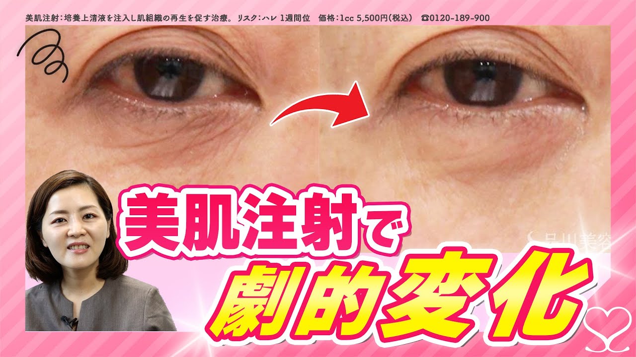 【シワ撃退】リジュランと同じ肌育治療 “ 美肌注射 ”の実力！#品川美容外科 #品川スキンクリニック