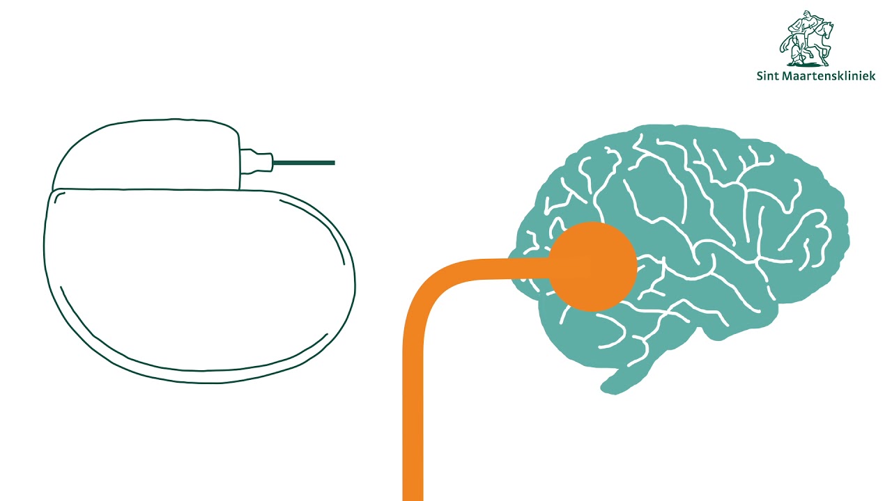 Neuromodulatie Sint Maartenskliniek