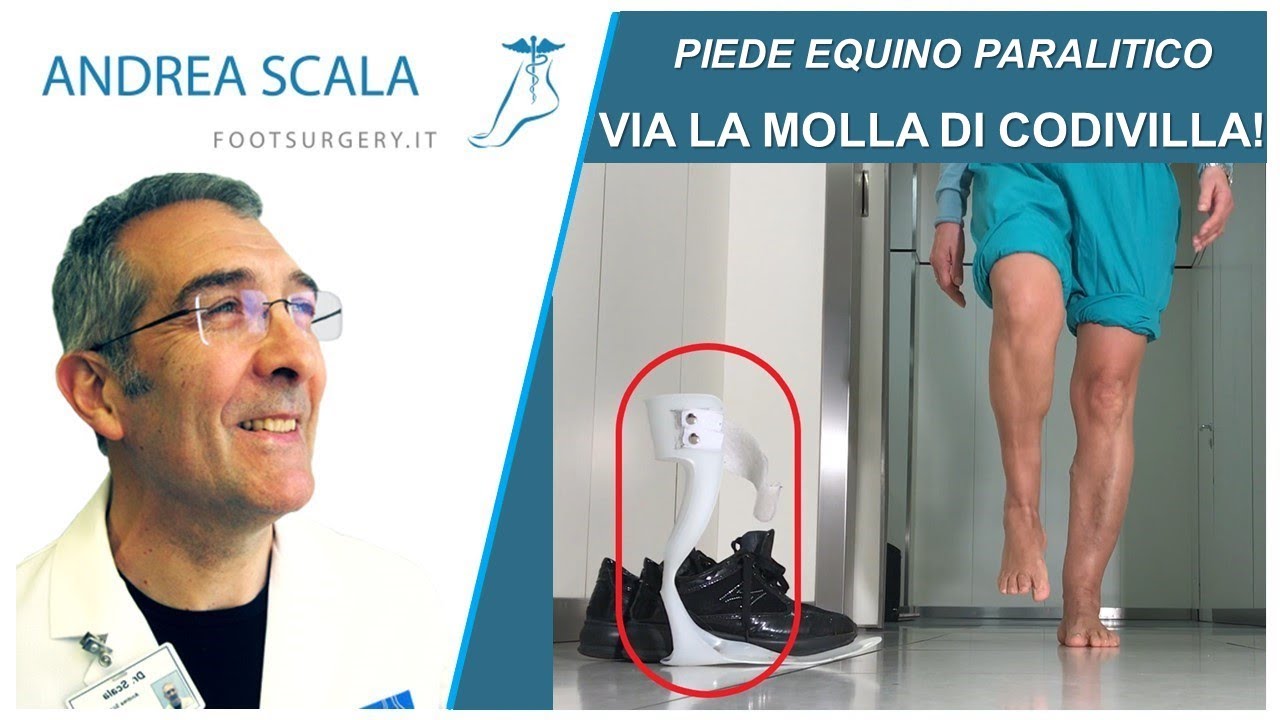 Piede Cadente Equino Paralitico : via la molla di Codivilla! | Piede Equino e molla di codivilla