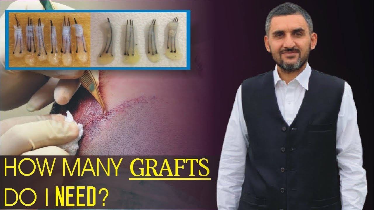 How Many Grafts | How many Hair Grafts Required | Dr. Habib clinic