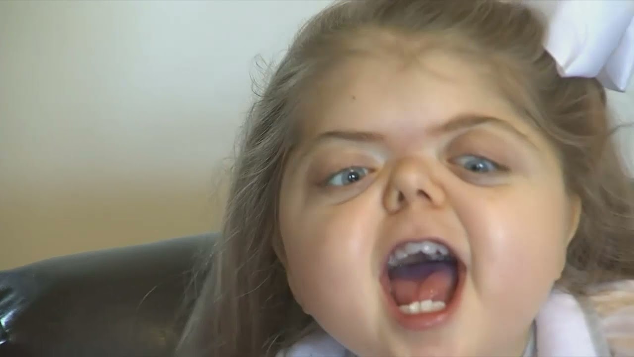 Dr. Larry Sargent performs life-changing craniofacial surgery on Ringgold girl