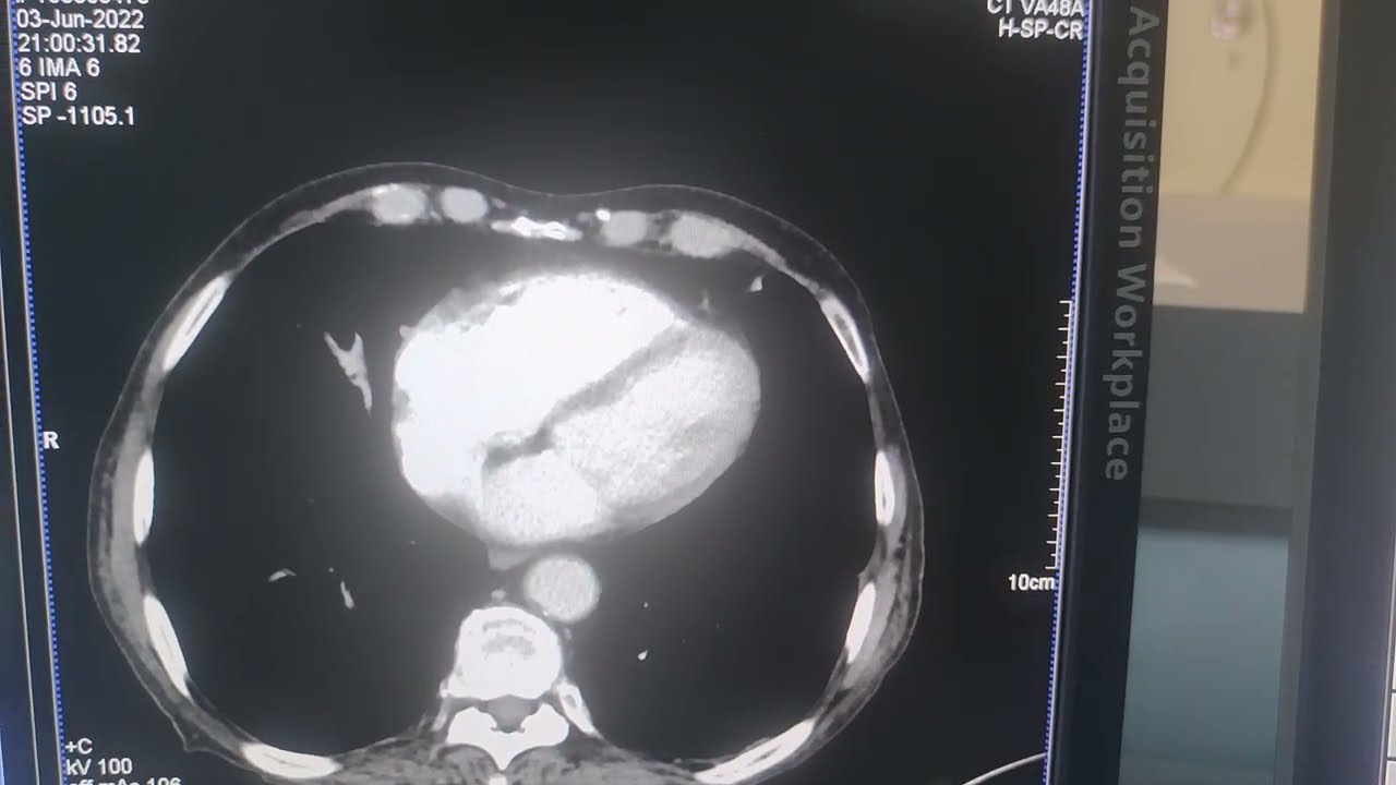 Tomografi de  alınan radyasyon nasıl hesaplanır? Tomografi çekmek ne kadar riskli, radyasyon alınır?