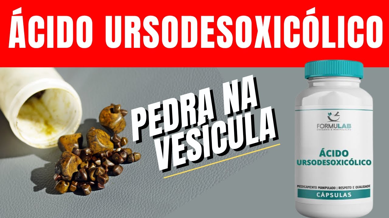 Ácido ursodesoxicólico dissolve a pedra na vesícula ? Ursucal funciona?