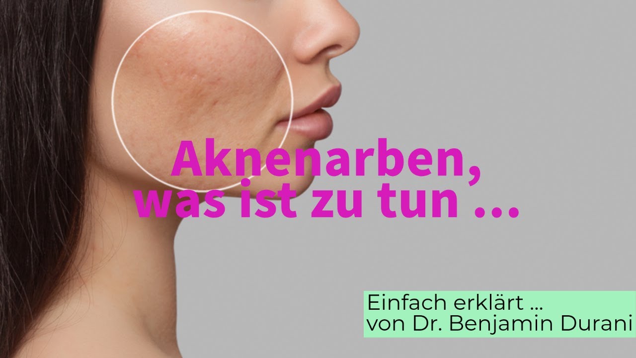 Akne Narben - Ursache & Behandlung - Einfach erklärt von Dr. Durani