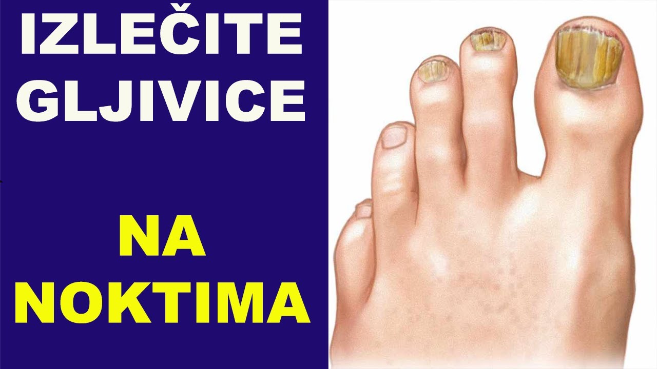 Izlečite GLJIVICE NA NOKTIMA/dr Bojana Mandić