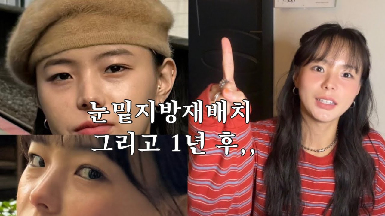 직장다니면서 눈밑지방재배치 & 1년 후기  | 멍없음 / 듀오덤X 바로 출근, 수술계기, 수술과정, 후기, 직후부기, 출근 