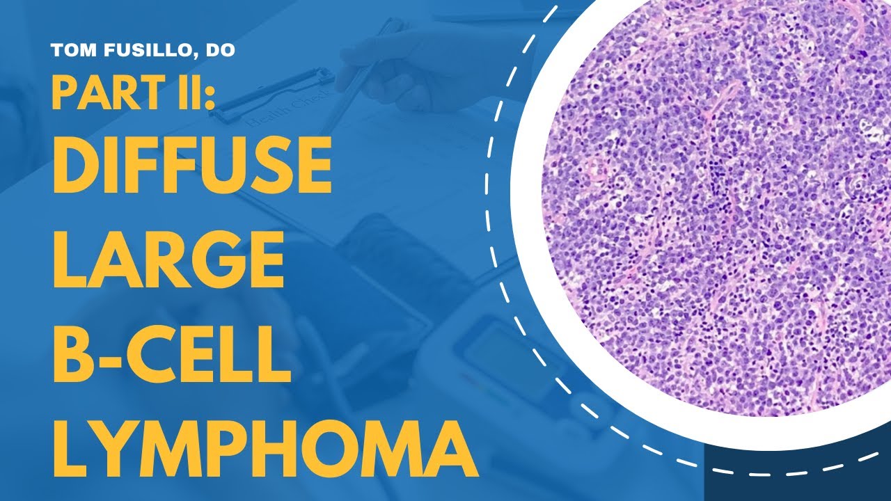 Diffuse Large B-Cell Lymphoma | Part 2: Treatment | R-CHOP, O-CHOP, DA-EPOCH-R, Pola-R-CHP, CAR-T