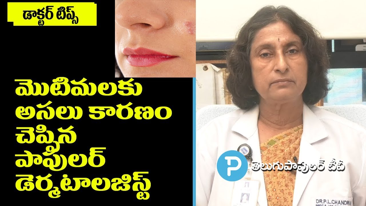 Main Causes for Pimples (Acne) Explained by Popular Dermatologist Dr Chandravathi