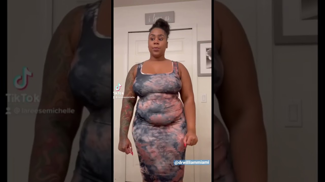 Before and After Tummy Tuck Results by Dr. William