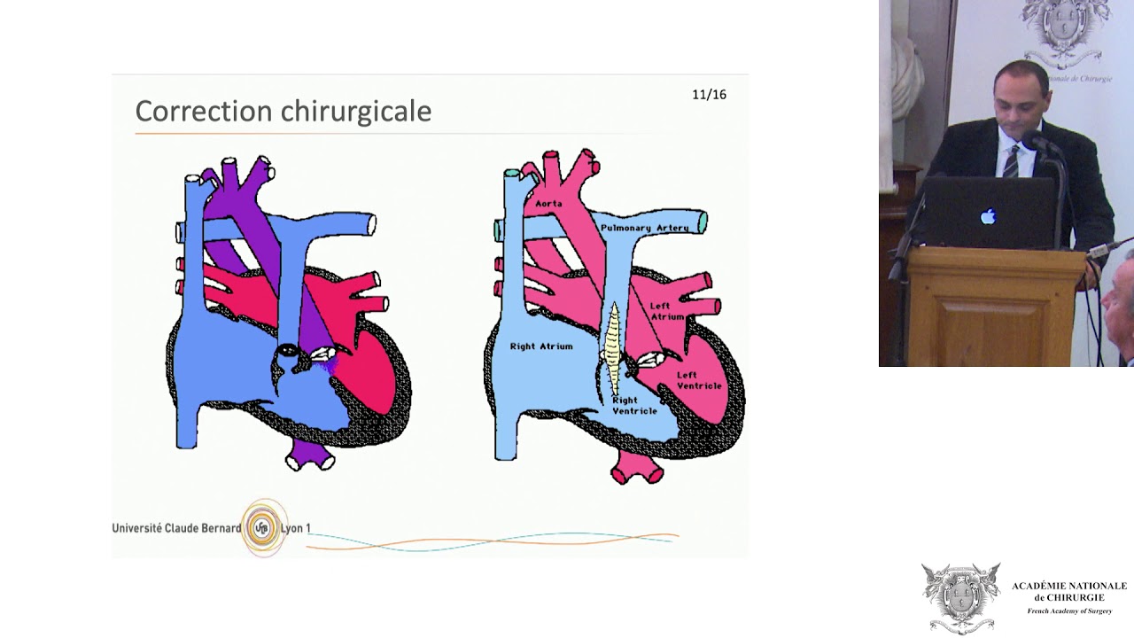 La tétralogie de Fallot