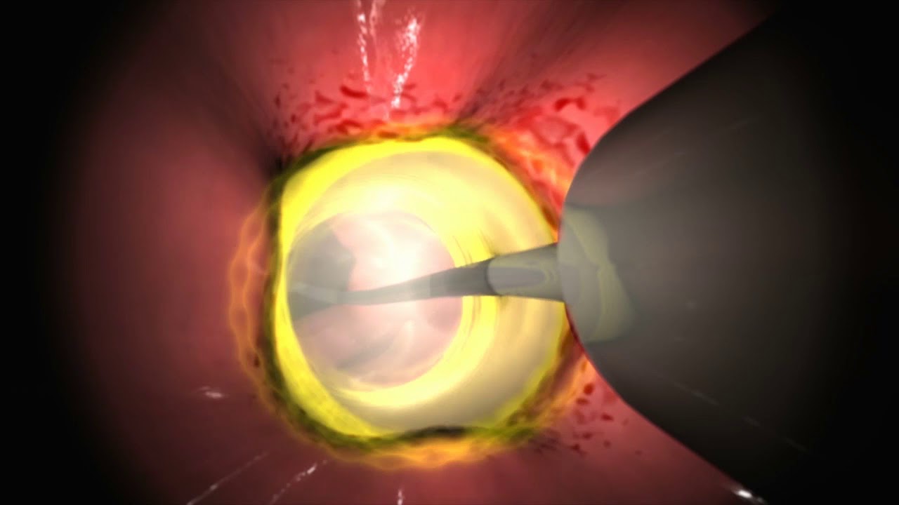 Radiofrequency ablation of the esophagus