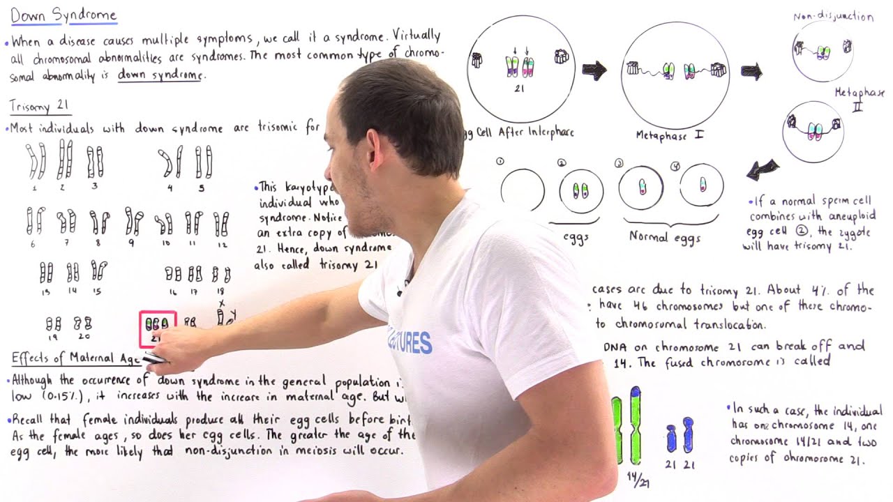 Down Syndrome (Trisomy 21 and Translocation)