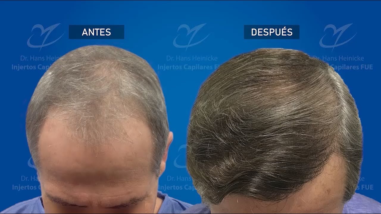 Injerto Capilar Madrid Técnica FUE 3173 Folículos (7226 pelos) Dr Hans Heinicke