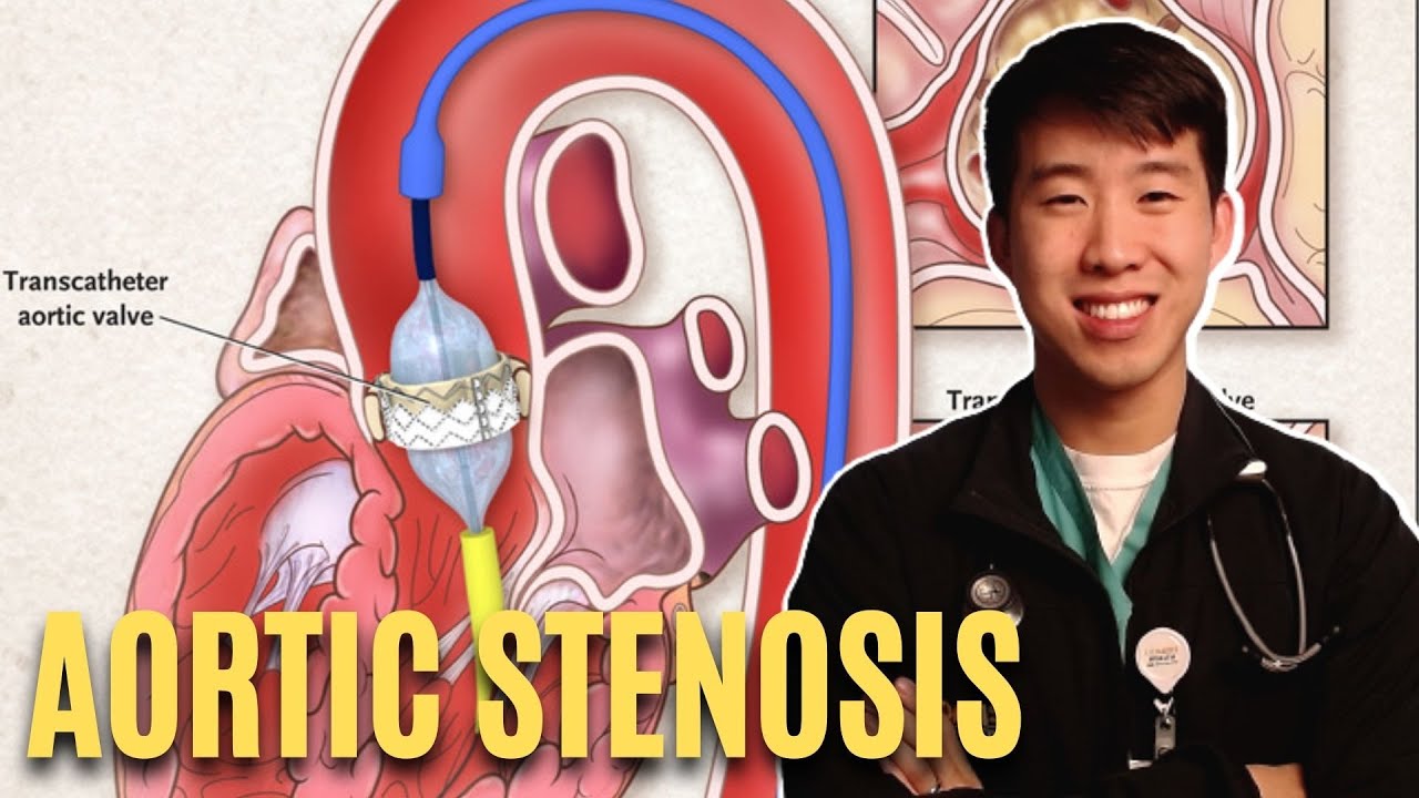 Everything You Need To Know About Aortic Stenosis