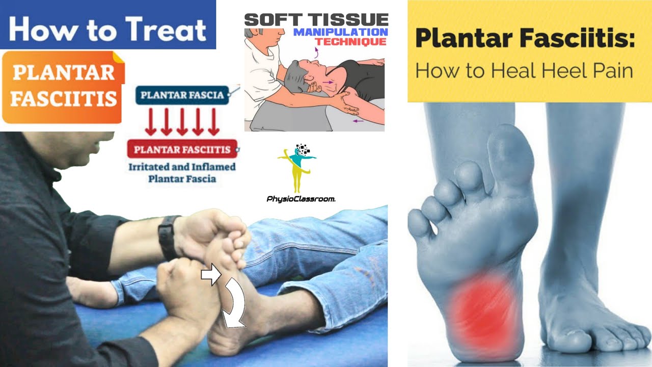 TREAT PLANTARFASCIITIS (HEEL PAIN) WITH SOFT TISSUE MANIPULATION TECHNIQUE.