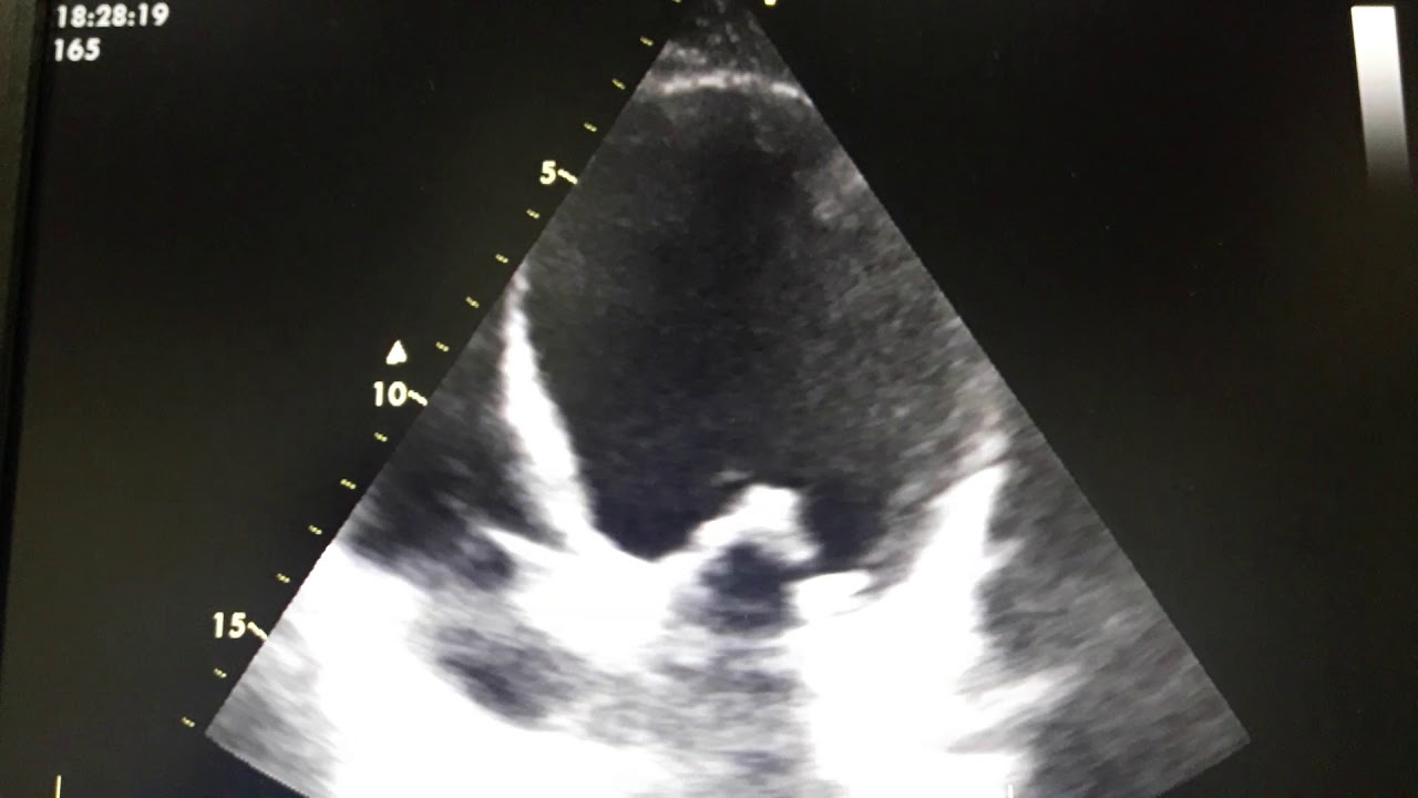 Young smoker male with dyspnea and orthopnea