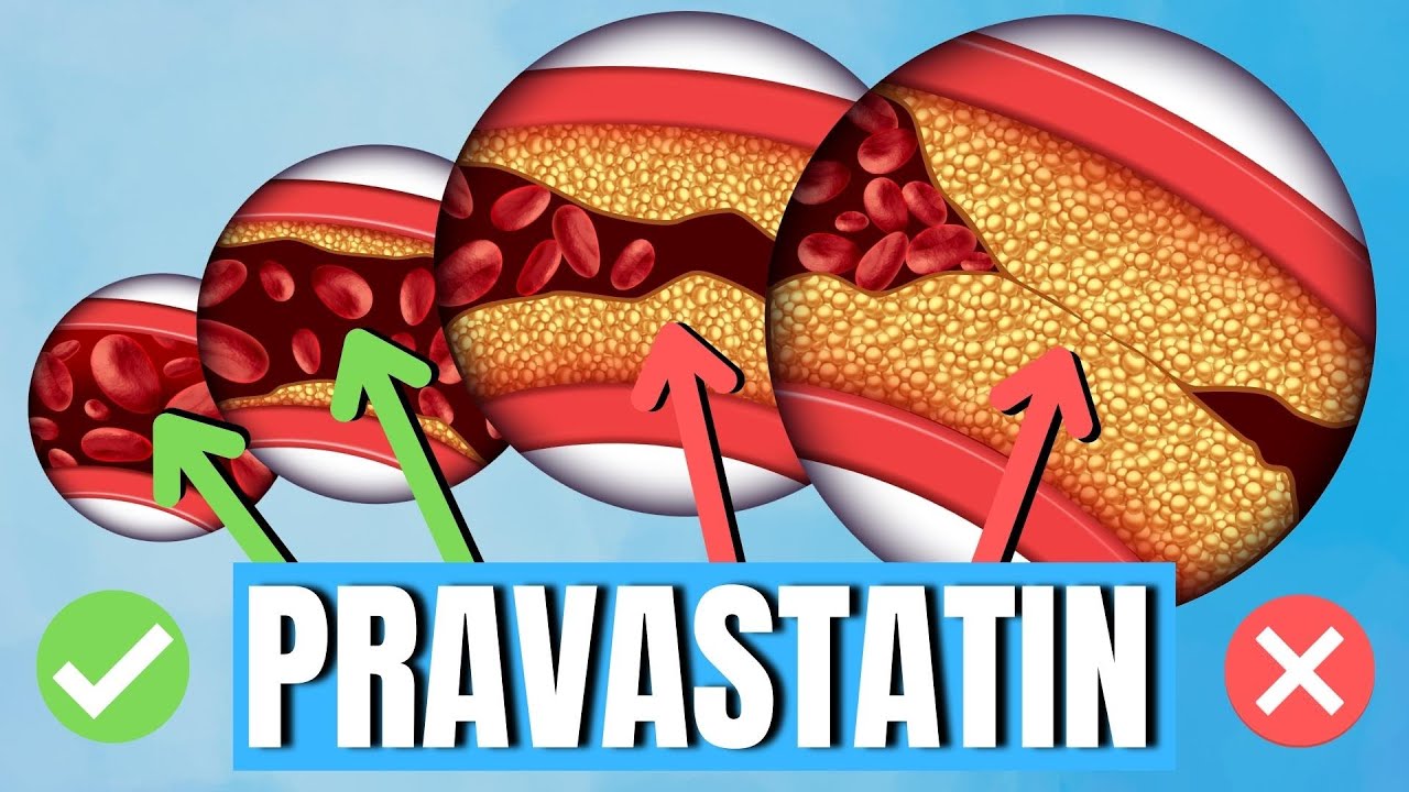 Как применять правастатин (правахол) — применение, побочные эффекты, дозировка — объясняет врач