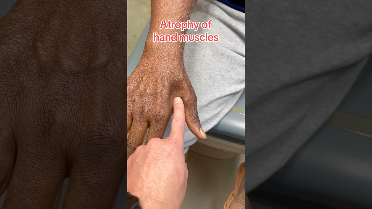 Atrophy of hand muscles - Ulnar nerve injury (Radial nerve not reviewed) #ulnarnerve #carpaltunnel