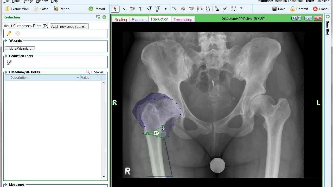Proximal Femoral Osteotomy | Deformity Correction Planning | Materialise OrthoView