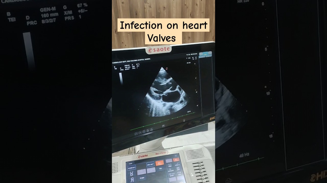 Infective endocarditis echo #echo #infection #medical #doctor #views #ultrasound #cardio #viral
