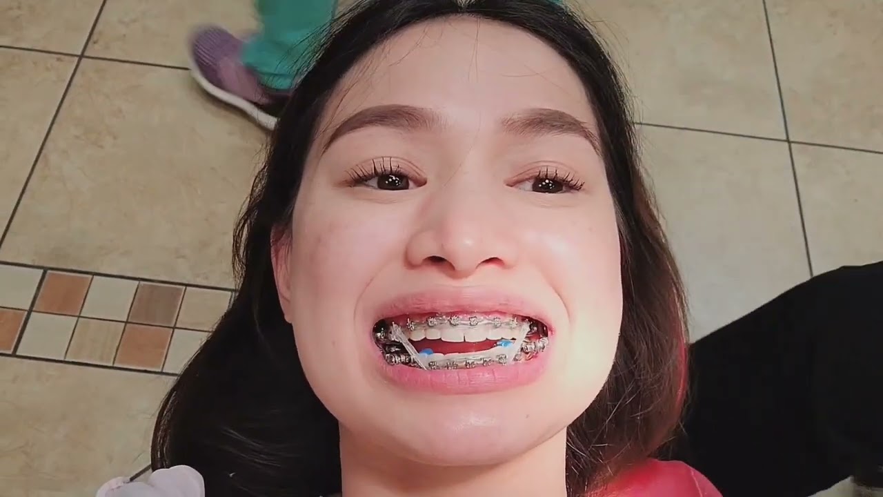 Update Monthly Adjustment Brace and Herbst Appliance