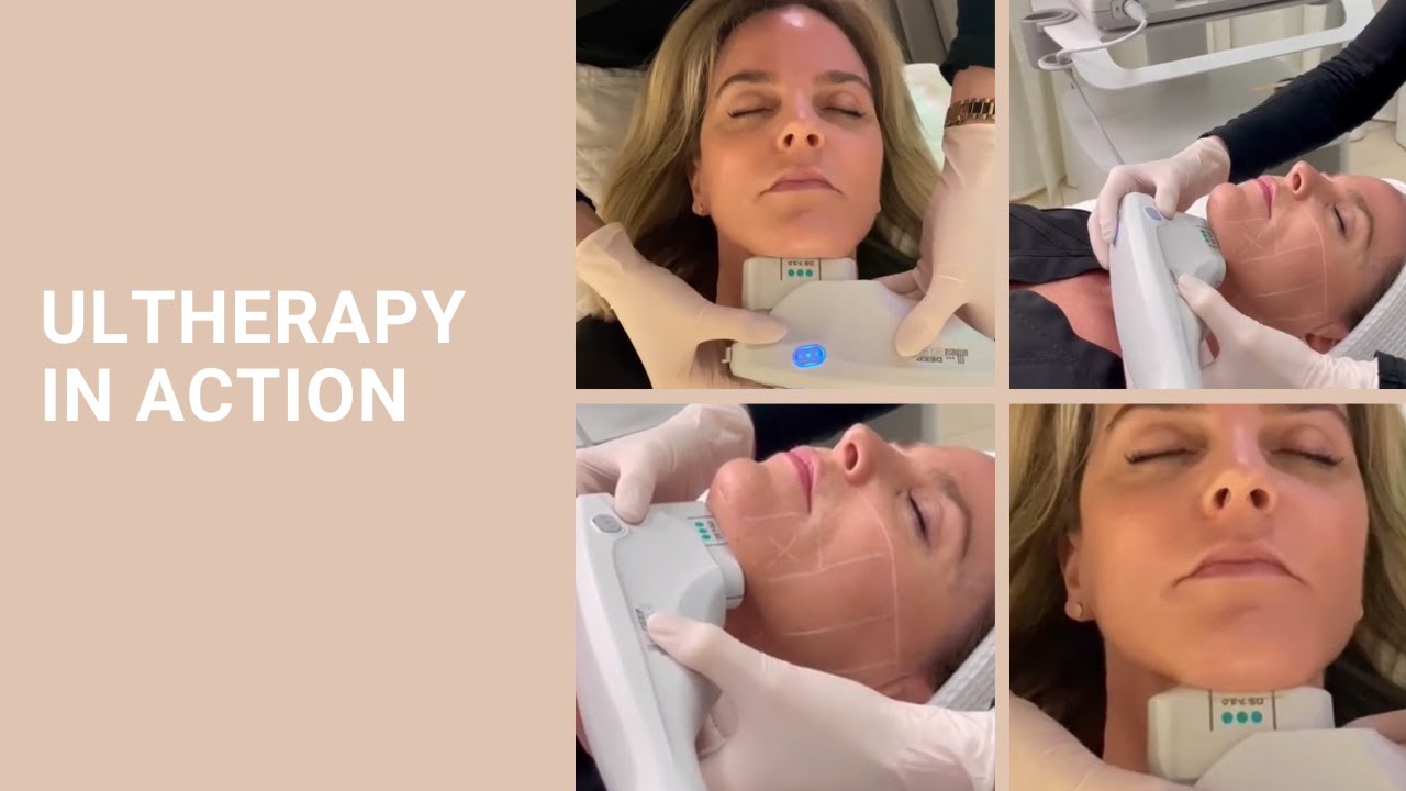Ultherapy in Action