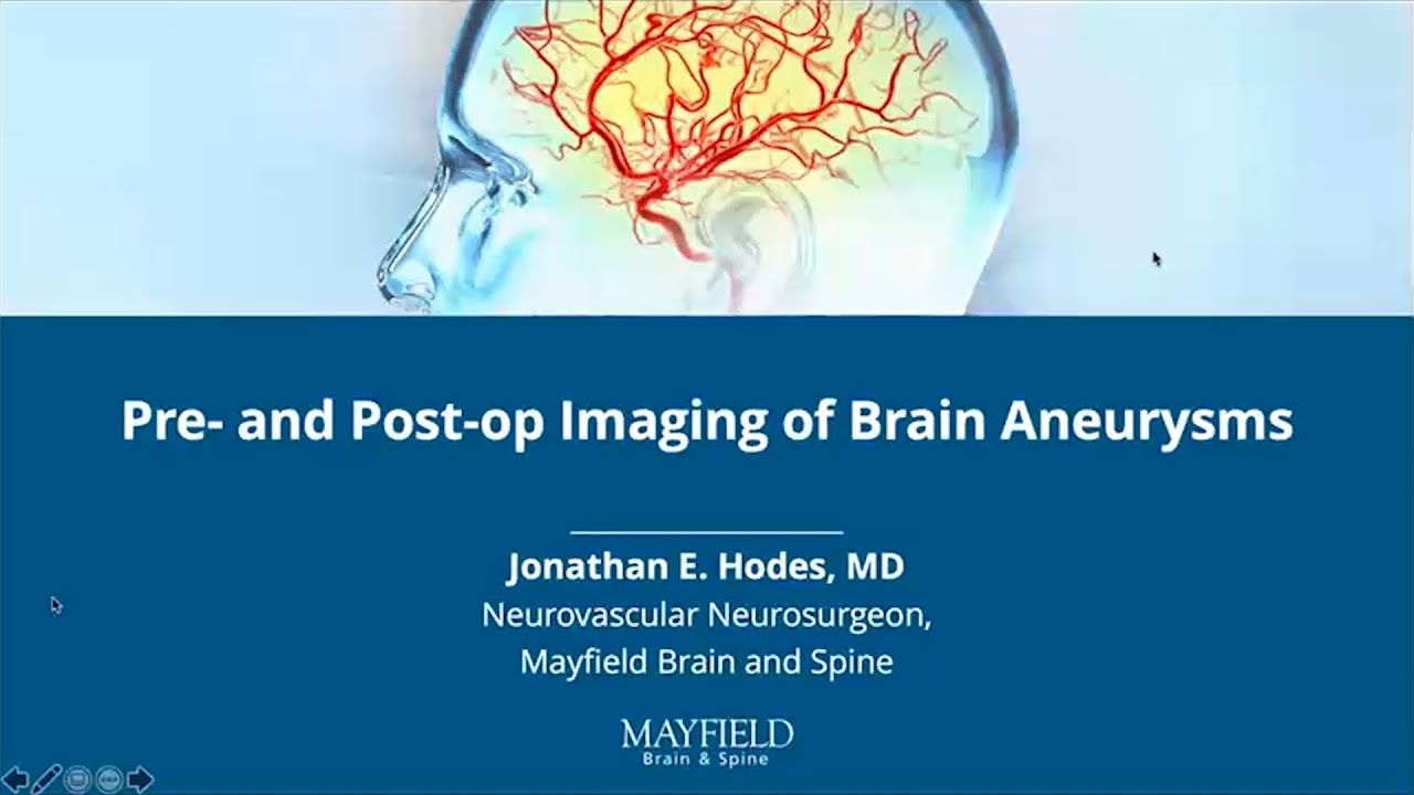 Pre- and Post-op Imaging of Brain Aneurysms w/ Dr. Jonathan Hodes