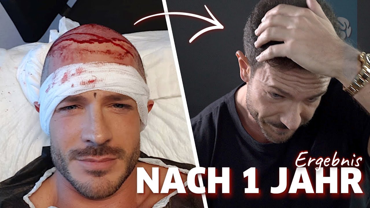 Ein Jahr nach meiner Haartransplantation | Ergebnis & Fazit