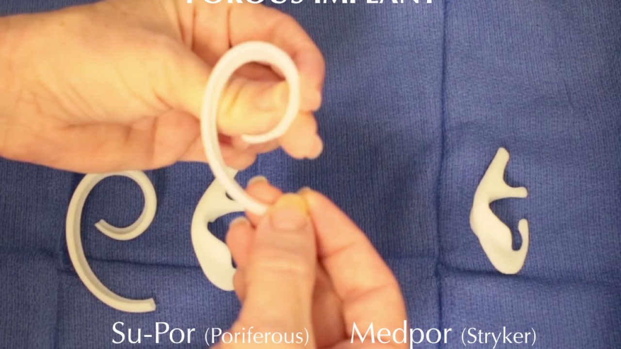 Porous Implants for Microtia Ear Reconstruction: Su-Por vs Medpor