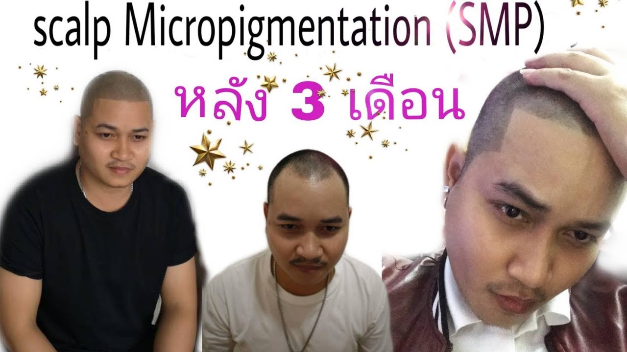 อัพเดตหลังทำ SMP 3 เดือน เหมือนผมจริง ใช้ชีวิตได้จริง ใครๆก็บอกว่าดูดีขึ้น