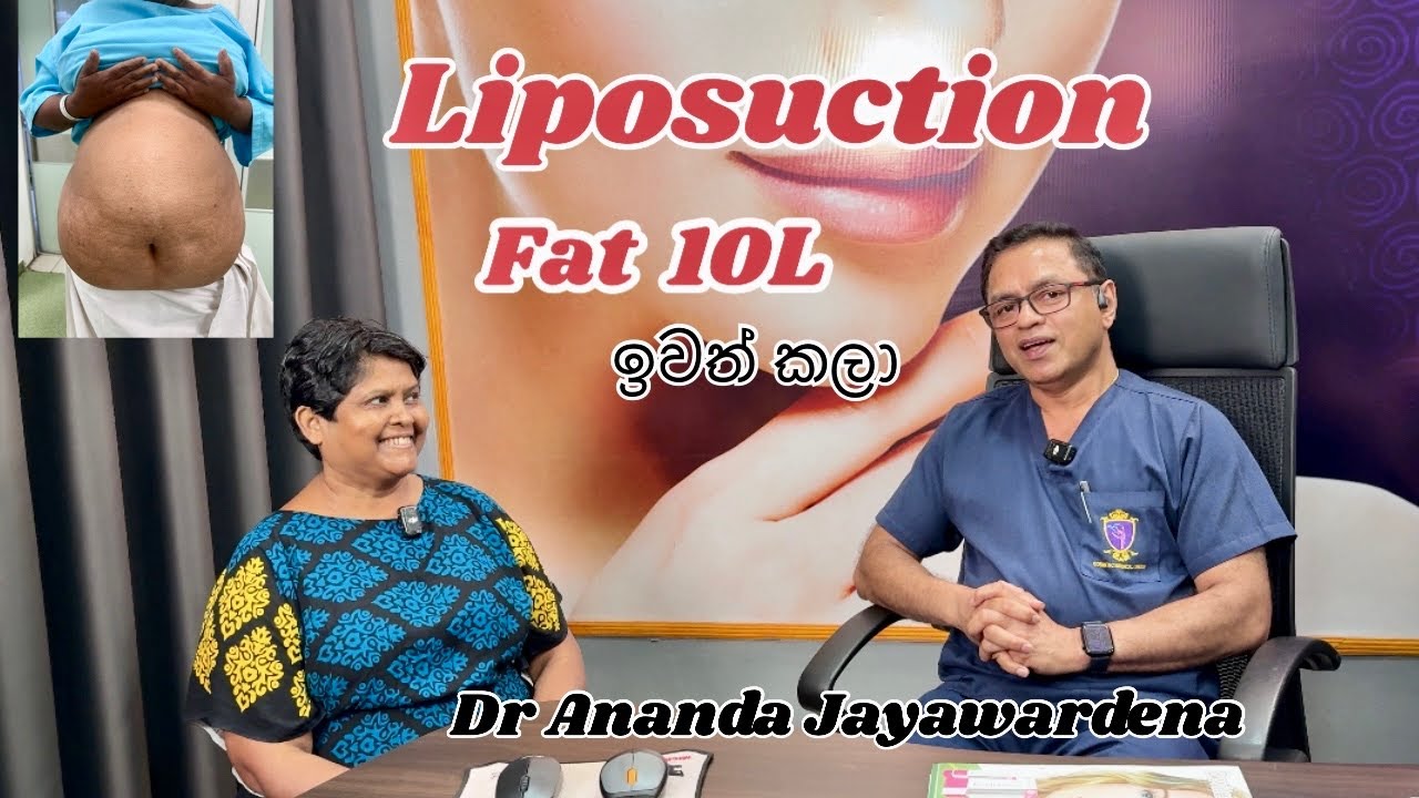 10L of Fat removed by 360 Liposuction. උදරයේ තෙල් ලීටර් 10ක් ලයිපොසක්ෂන් මගින් සාර්ථකව ඉවත් කලා 