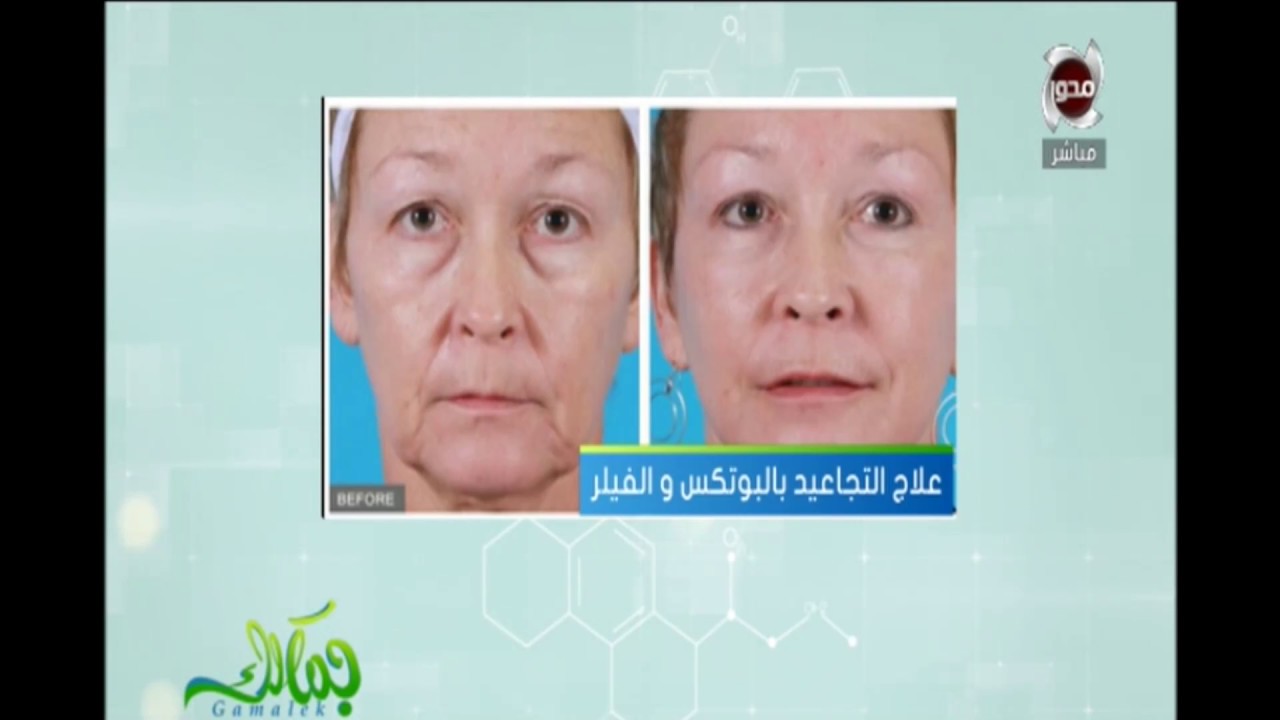 د/ ايمان الشربيني تتحدث عن الفرق بين الهايفو و البلازما جيت لعلاج التجاعيد - جمالك
