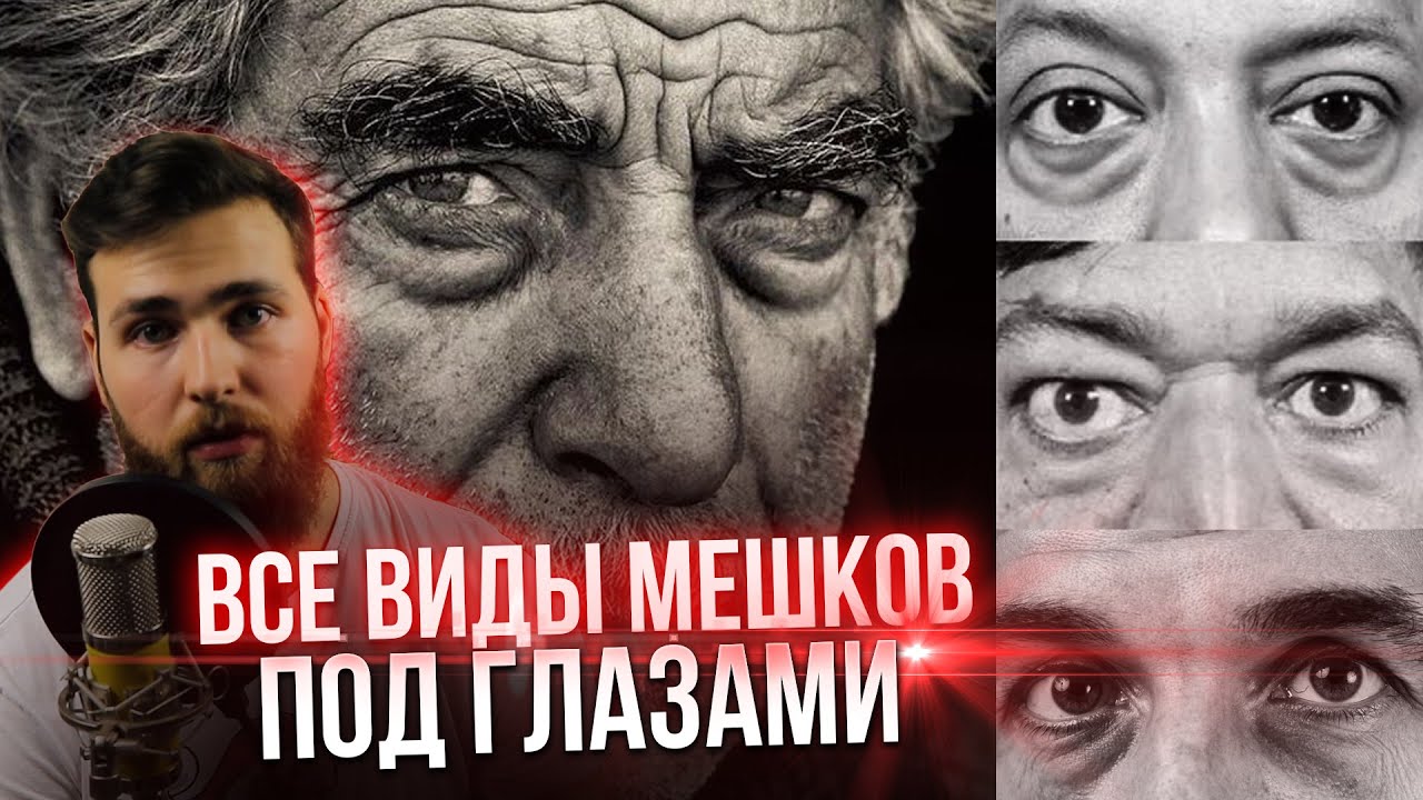 Малярные Мешки под глазами как убрать Синяки под глазами