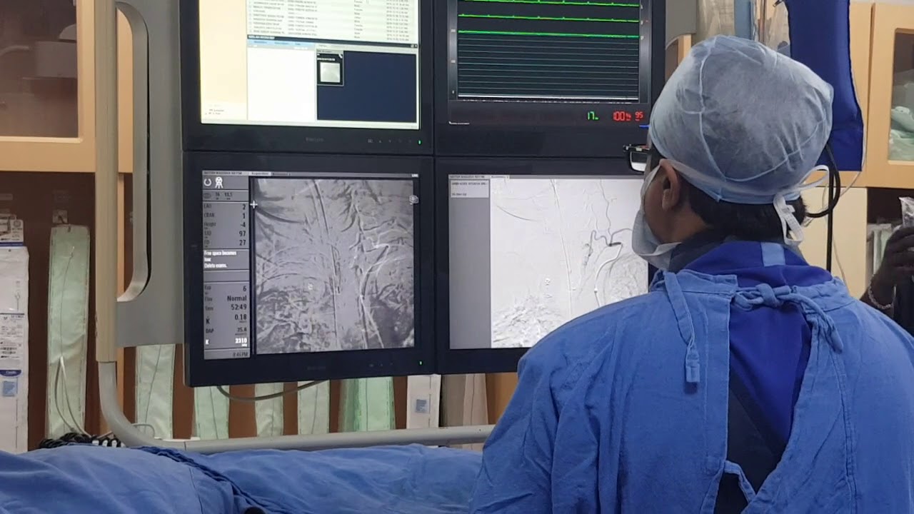 Embolisation of slowly bleeding esophageal cancer