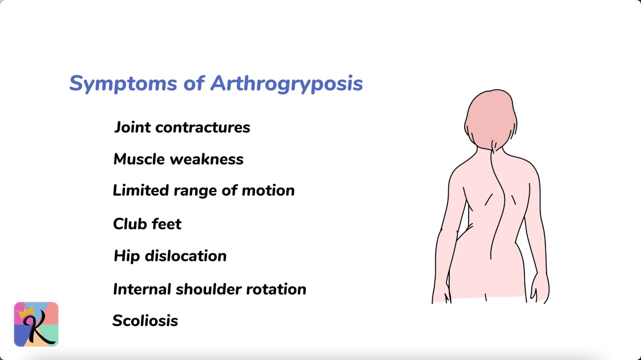 Understanding Arthrogryposis: Causes, Symptoms, Diagnosis, and Treatment