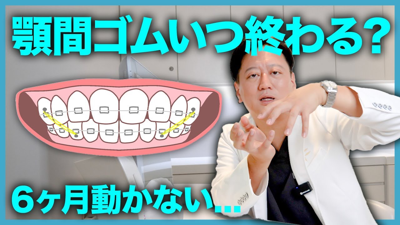 ゴム掛けはいつ終わる？ 矯正治療で必須の顎間ゴムの仕組みや期間についてお話しします【審美歯科 歯並び 歯列矯正 噛み合わせ】