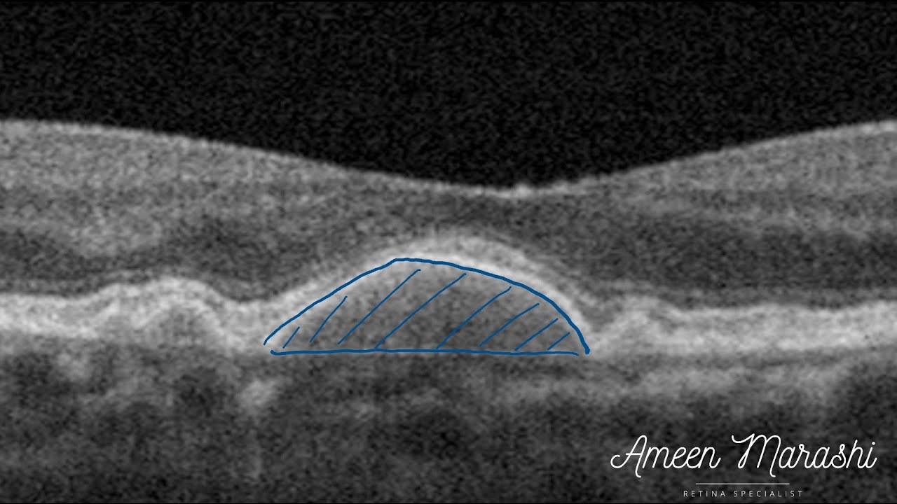 Course in clinical applications of OCT for macular diseases - Non-neovascular ARMD