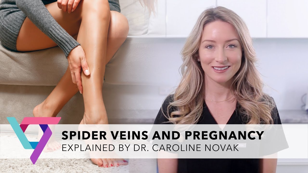 Medical Center: Spider Veins and Pregnancy | Spider and Varicose Vein Treatment Center