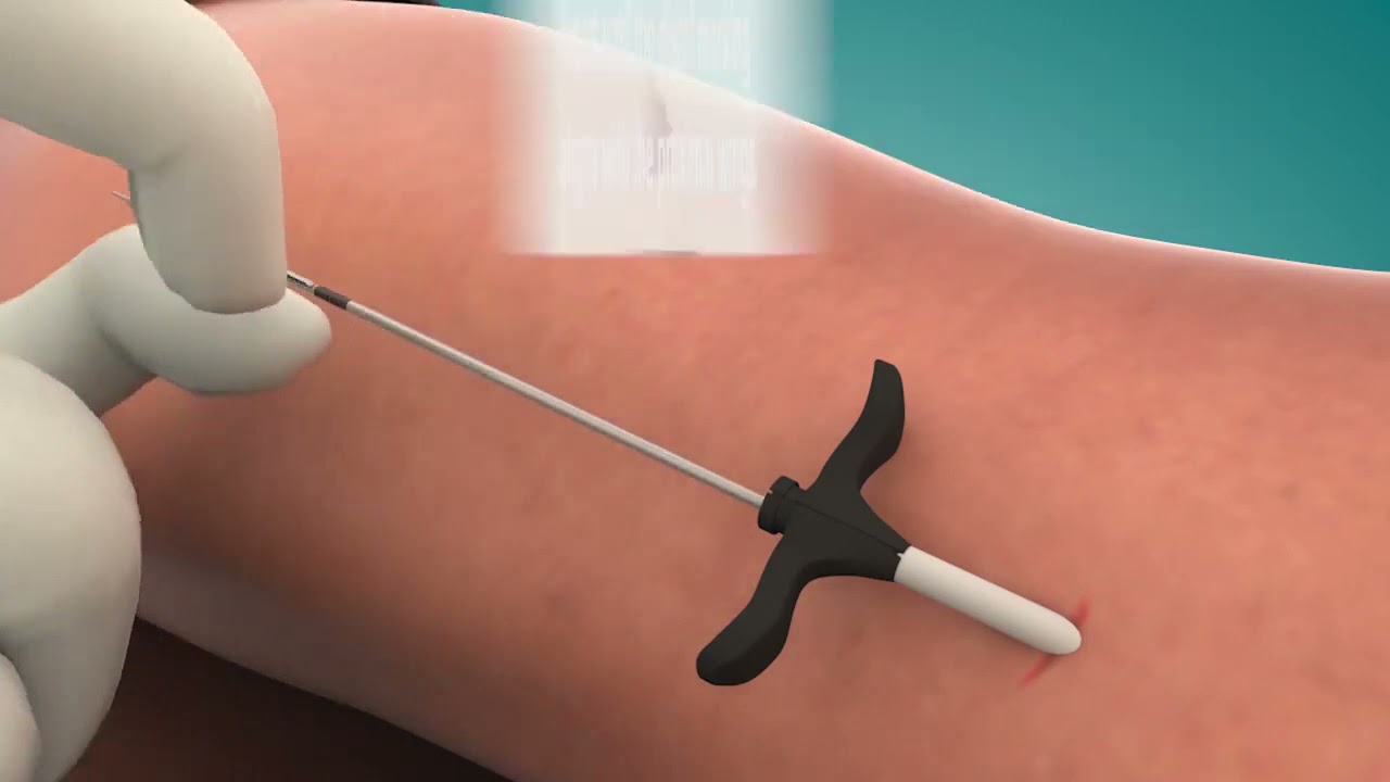 StimRouter Procedure Animation | Tibial Nerve Implant Using Single-Incision Technique