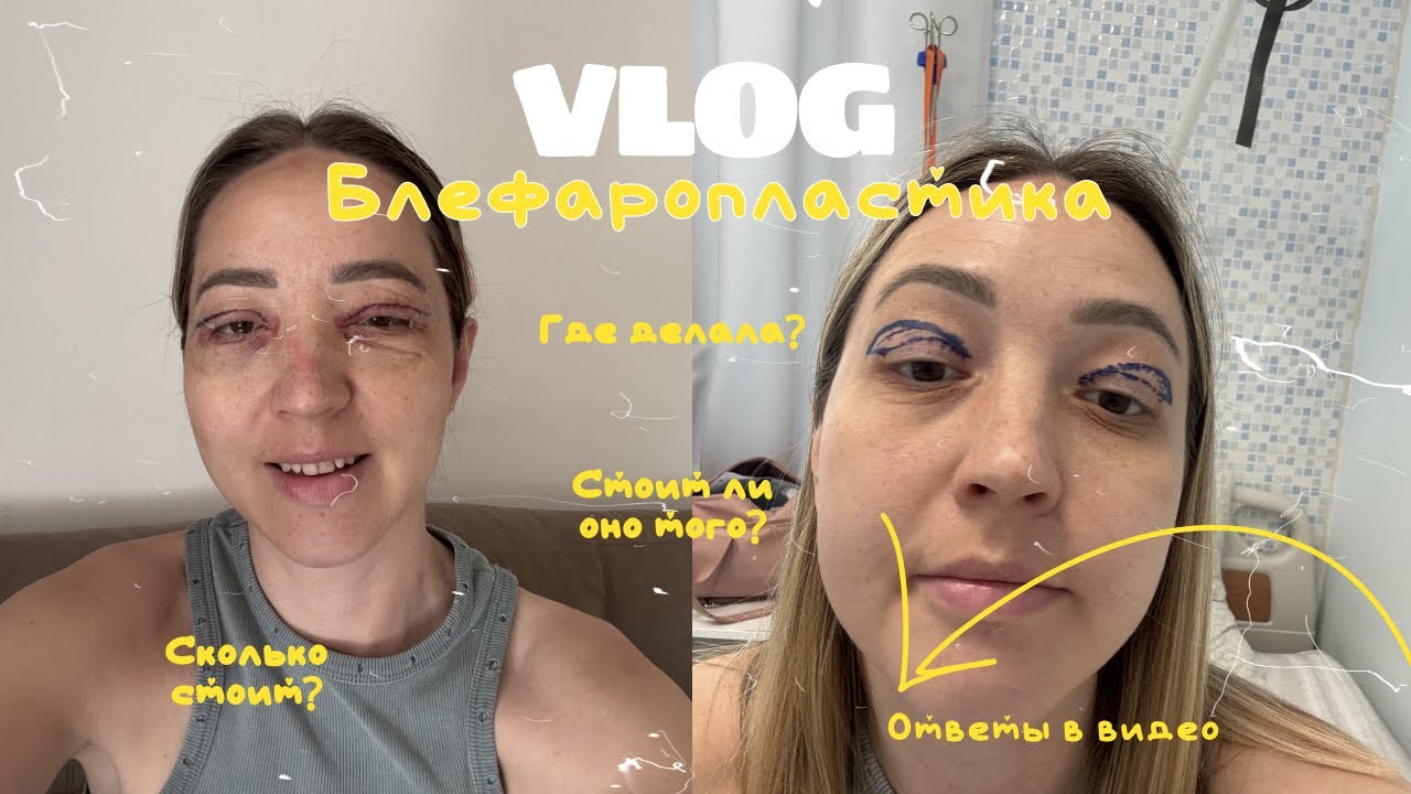 Мой честный опыт блефаропластики / я сделала операцию и вот что из этого вышло 