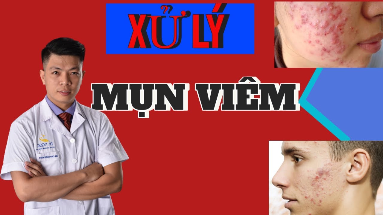 TRỊ MỤN VIÊM - Cách Điều Trị Mụn Viêm Sưng Đỏ | Dr Ngọc