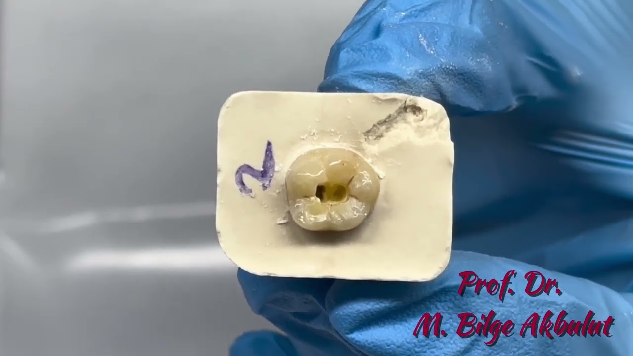 Endodontic Access Cavity Preparation on a Lower Molar / Alt molar dişte endodontik giriş kavitesi