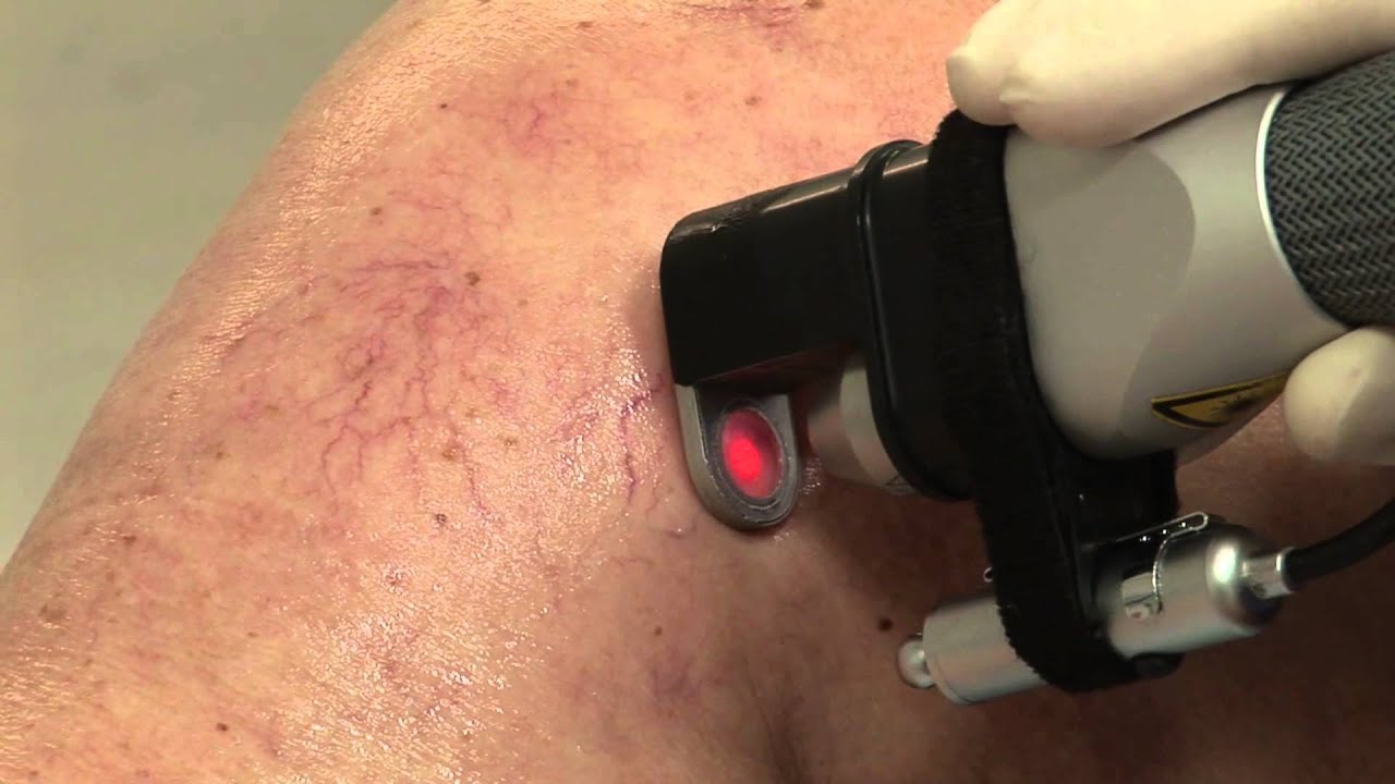 Besenreiserbehandlung mit dem Laser
