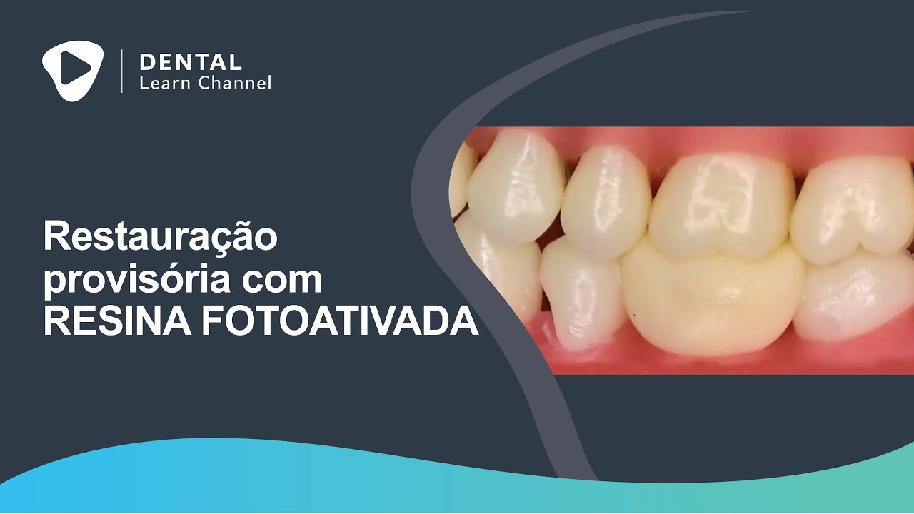 Restauração provisória com resina fotoativada
