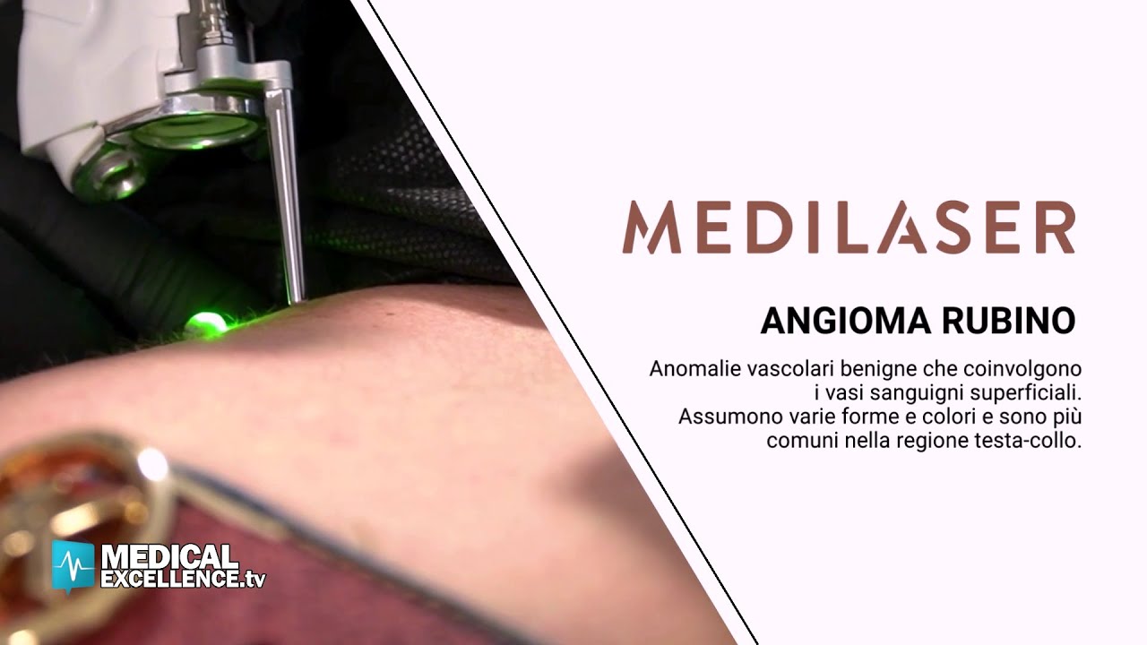 Angioma Rubino, rimozione in 5 minuti completamente indolore