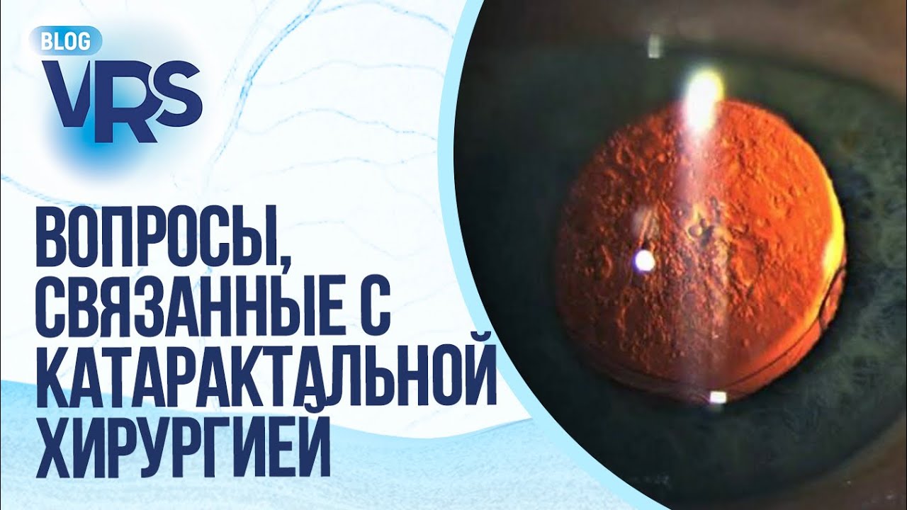 Вопросы, связанные с катарактальной хирургией