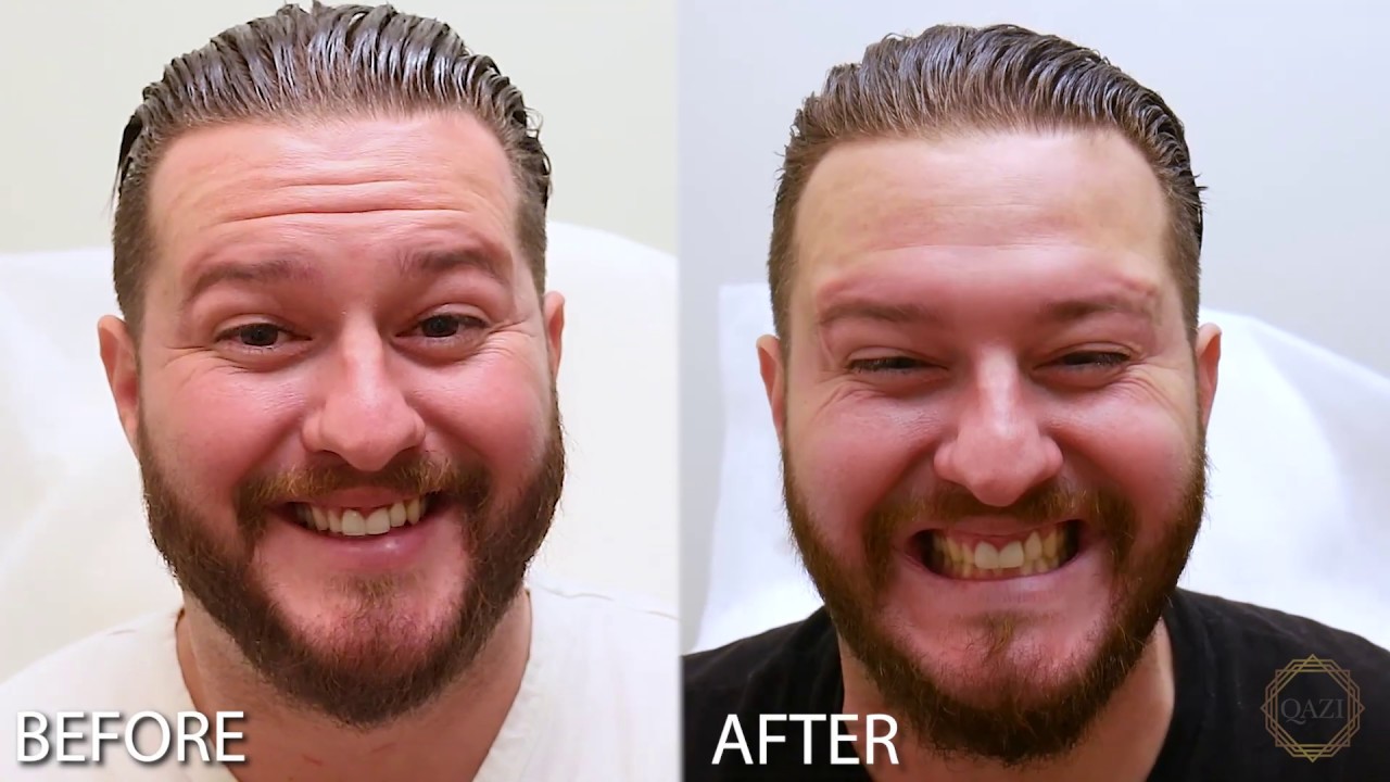 Botox Before & After For Men - Irvine, CA (Using Botox, Xeomin, Dysport)
