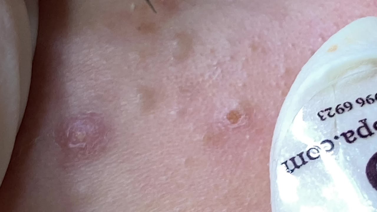 Pimples On The Chin | Mụn Ẩn Nổi Ở Cằm - SacDepSpa#131